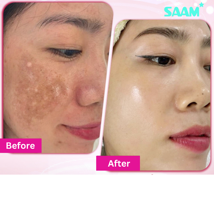 Crème  Anti-Taches Mélasma & Tâches hyperpigmentaires & Éclaircissante