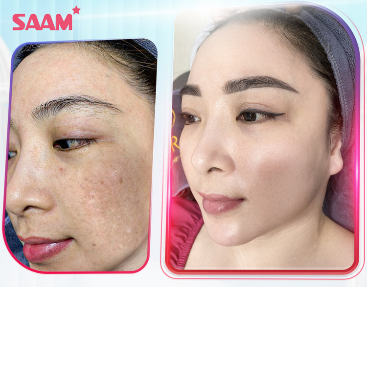 Crème  Anti-Taches Mélasma & Tâches hyperpigmentaires & Éclaircissante