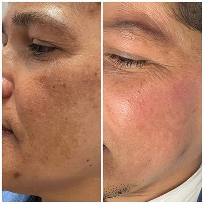 Crème  Anti-Taches Mélasma & Tâches hyperpigmentaires & Éclaircissante
