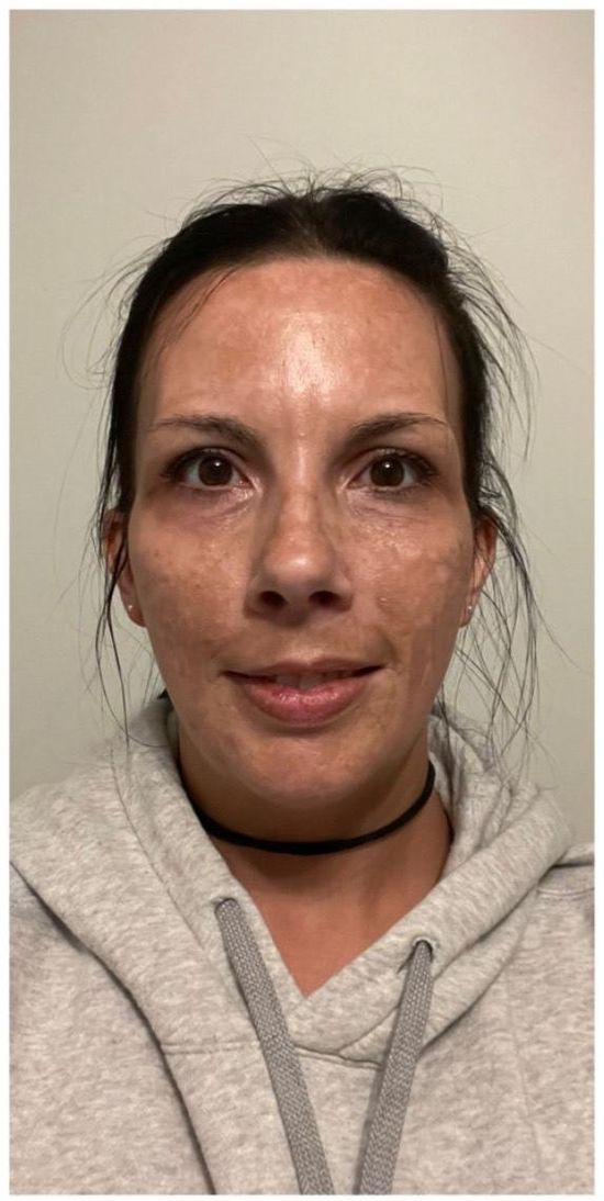Crème  Anti-Taches Mélasma & Tâches hyperpigmentaires & Éclaircissante